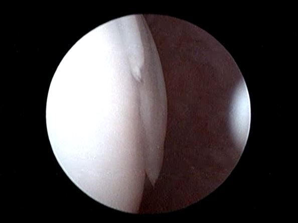 cartilage flap in situ